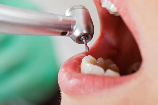 Best Emergency Tooth Extraction in Denton, TX